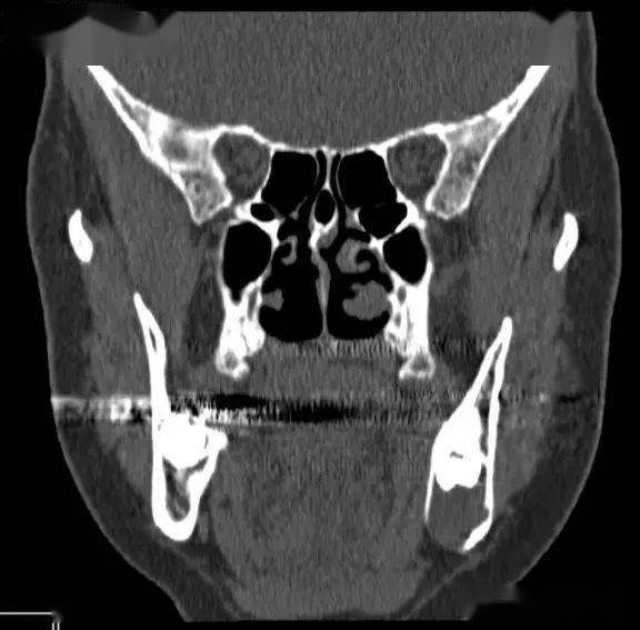 含牙囊肿影像诊断