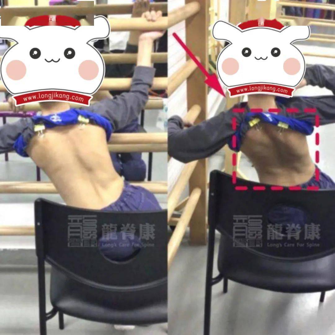 病例先天运动神经元受损的脊柱侧弯孩子该如何治疗