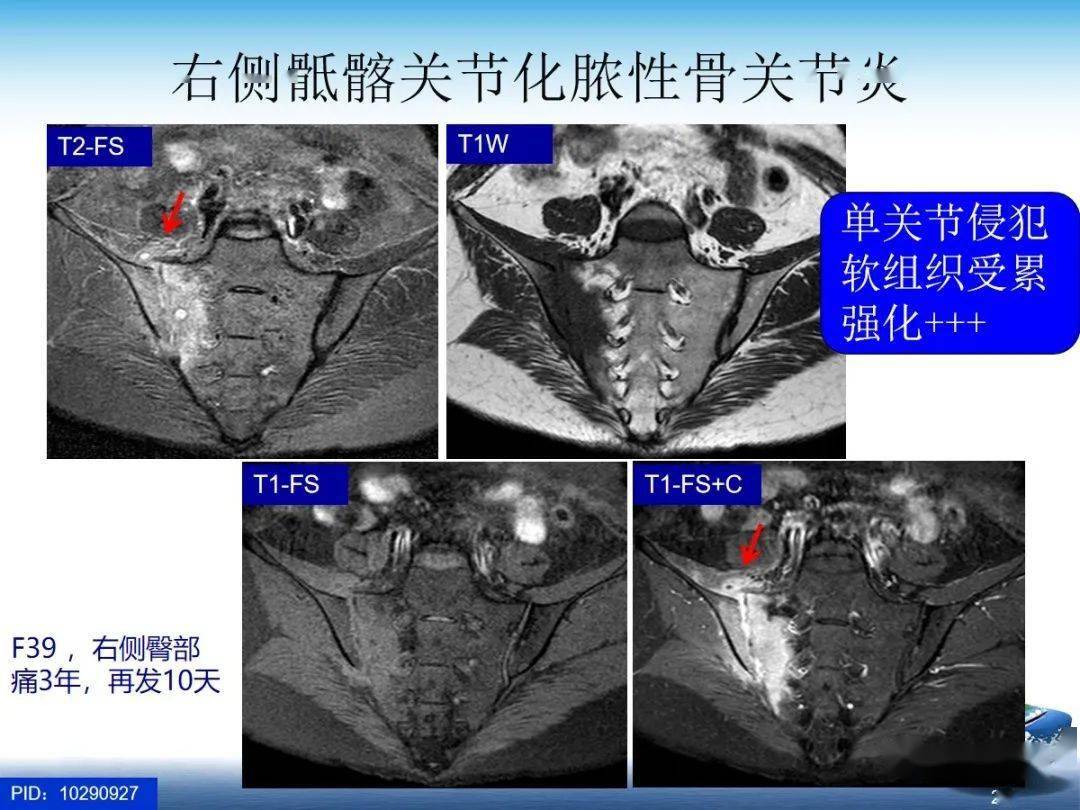 spa骶髂關節炎的影像學診斷與鑑別