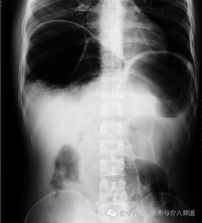 气往高处走这些气腹征象你应该掌握