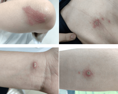 夏秋季很多,毒液ph值相当于浓硫酸_金女士