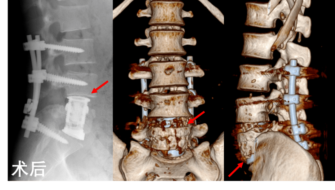 新闻嘉一首例后路一期椎体切除减压人工椎体植入术重建青年的人生脊梁