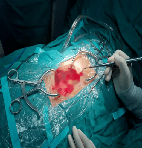 9岁患儿先天性脊柱侧弯骨科医生通过手术成功矫正新技术