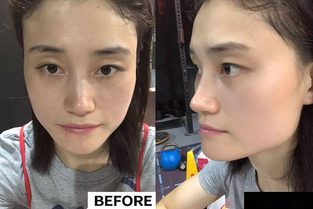 28岁初衰老之后,脸变更肿又下垂,被老板在背后说:脸像一个饼,形象不好