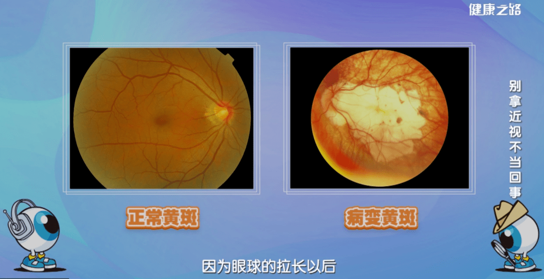 小心因為忽略近視問題而致盲視網膜脫離黃斑病變