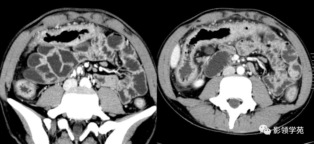 病理基礎 結節病樣肉芽腫(非乾酪樣壞死性肉芽腫) 鋪路卵石樣粘膜表現