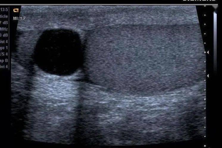 右侧睾丸附睾囊肿图片图片