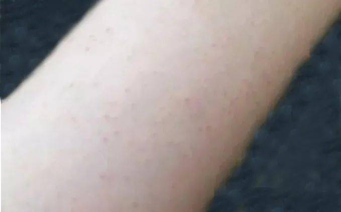 下颚粗糙鸡皮肤(脖子两侧皮肤粗糙鸡皮肤)