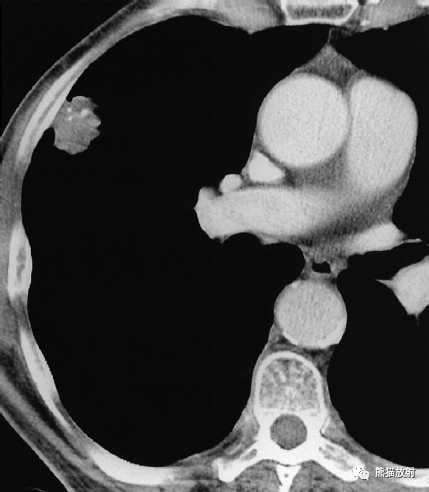 小部分肿瘤因肿瘤内营养不良性钙化导致不定形和云雾状钙化表现(小于