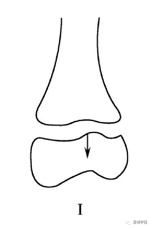 Ⅰ型 骨骺分離.可有或者沒有移位,應力位x線片有助於確診.