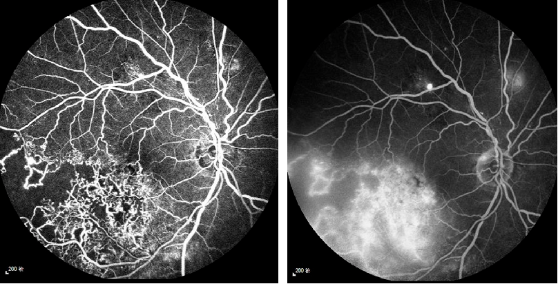 每周最佳病例分享octa全程指导下的精准视网膜光凝