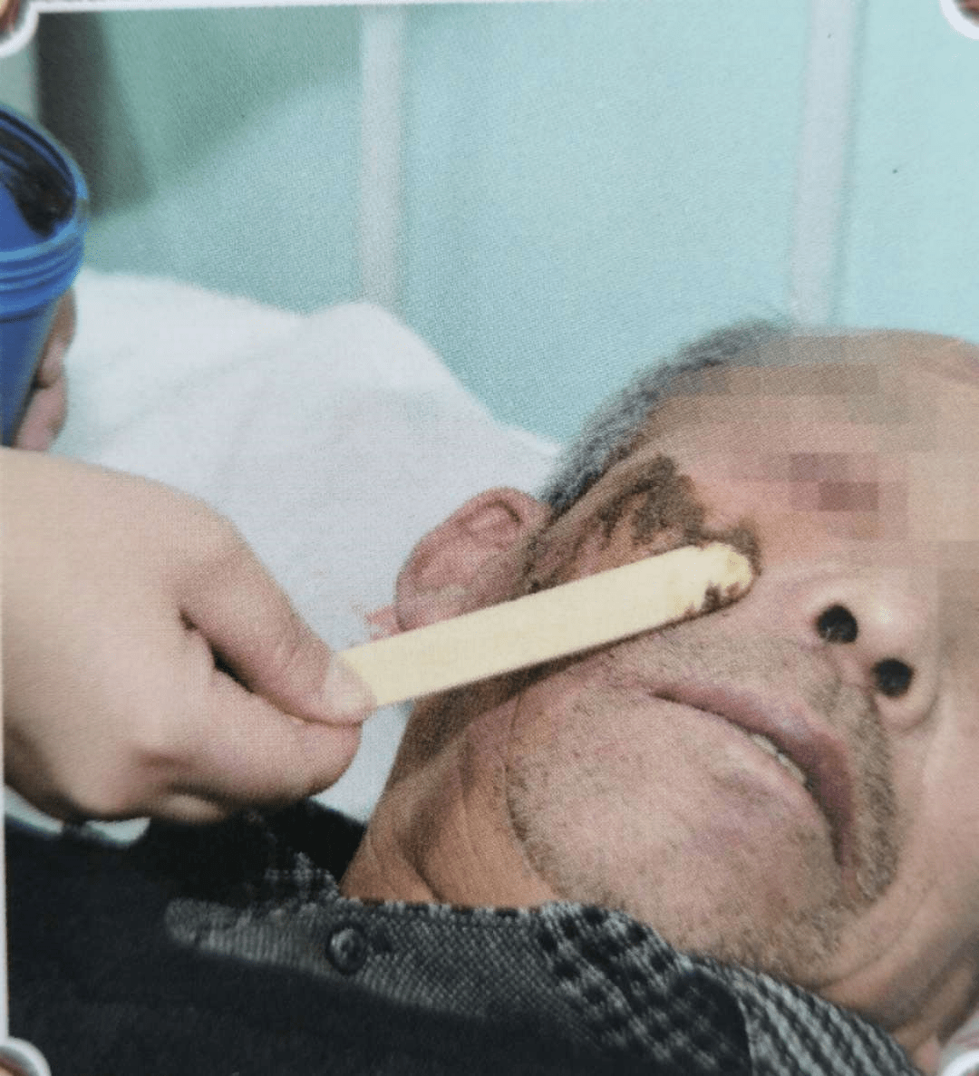 中药外敷治疗面神经炎