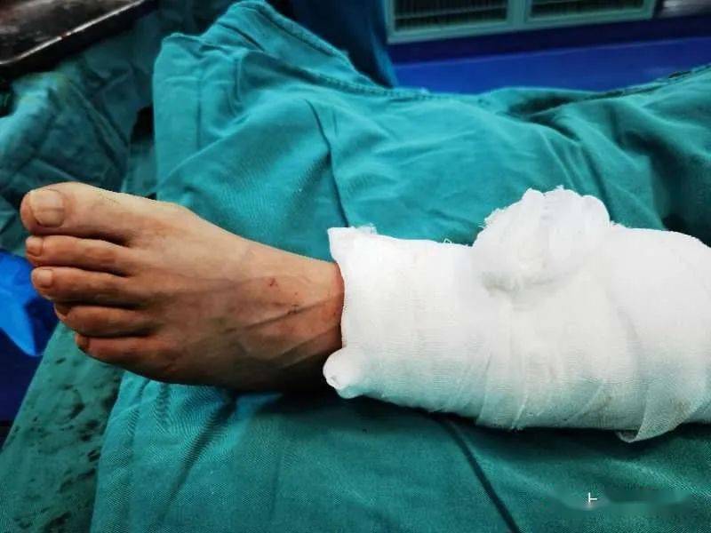 扁鹊之手再次接活离体断肢