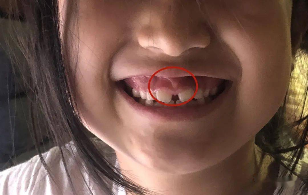 普及一下,上唇系带就是连接上唇和上牙龈之间的那根筋