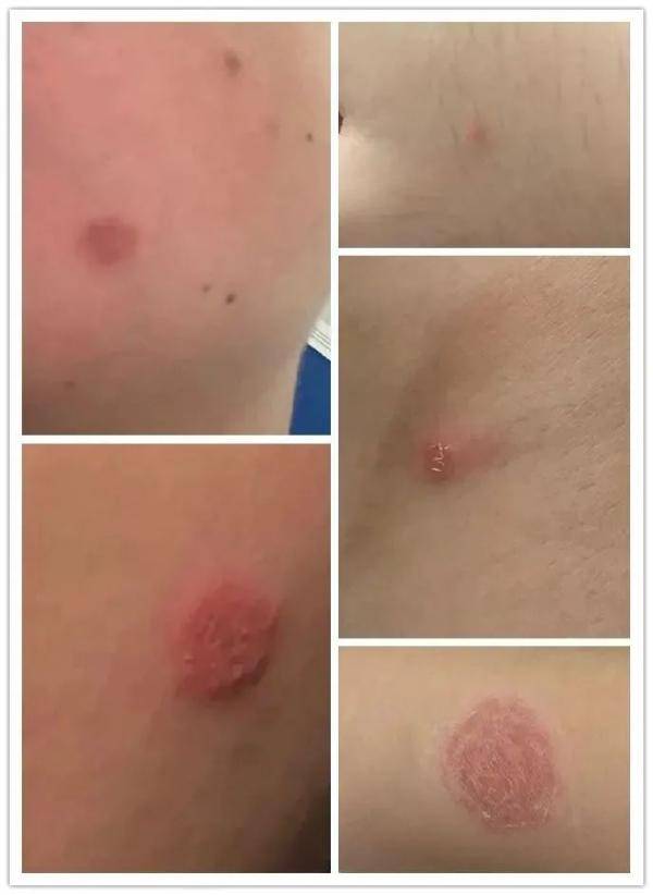 须癣毛癣菌人得猫藓