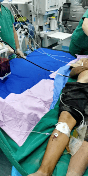 髓腔穿刺输液技术的应用骨髓腔输液通路技术(intraosseous,io)俗称"