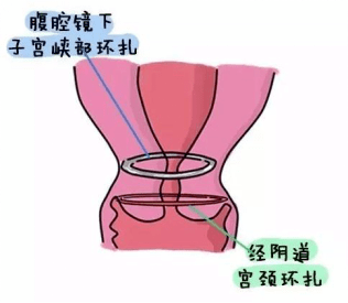 新技术腹腔镜下宫颈环扎术圆宫颈机能不全女性母亲梦