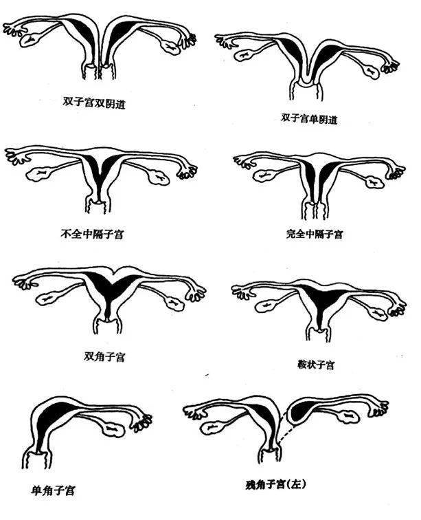 子宫畸形种类图片