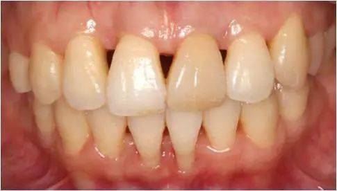 患者仍然存在21变色及下颌中切牙角化龈宽度较窄的问题修复科会诊后