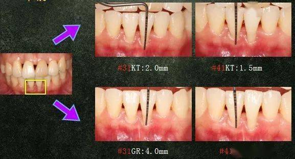 局限型侵袭性牙周炎及牙龈退缩治疗病例分享