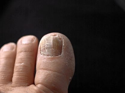 经历过的都知道,有了灰指甲真的很烦!