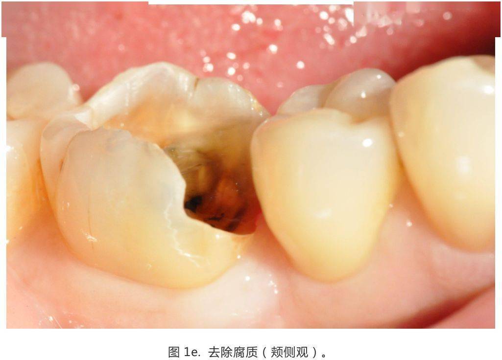 【病例分享】龈壁抬升的研究_边缘