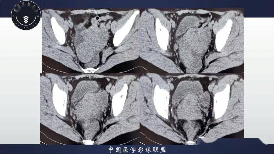 卵巢囊腺瘤ct表现图片图片