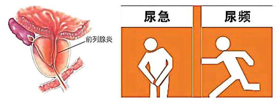 慢性前列腺炎