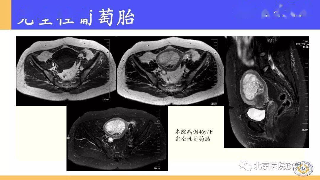 形态变异主要异常胎盘的mri特征:磁共振/核磁孕期检查