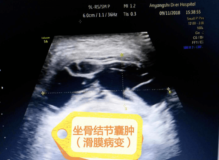 坐骨结节性囊肿为臀部长出硬疙瘩的症状,这是由于人体的坐骨结节和椅