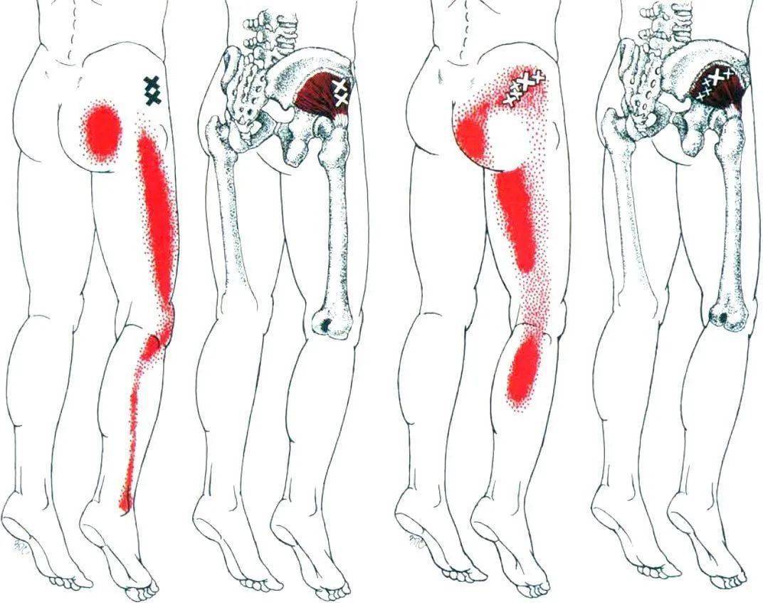 臀部大中小肌的解剖分析评估及训练方案