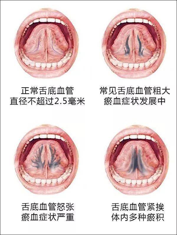 舌下取栓图片位置图片