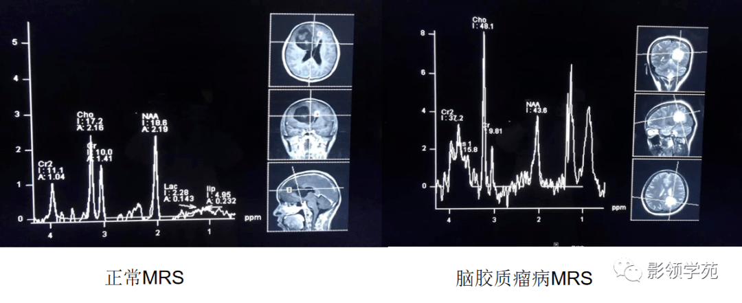 並累及胼胝體壓部雙側,左側扣帶回峽部,信號稍混雜,病灶中央呈長t1,長