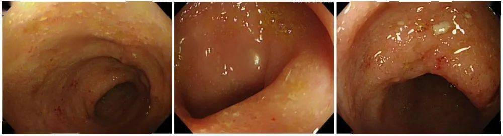 目前,没有人确切知道溃疡性结肠炎发生的原因.