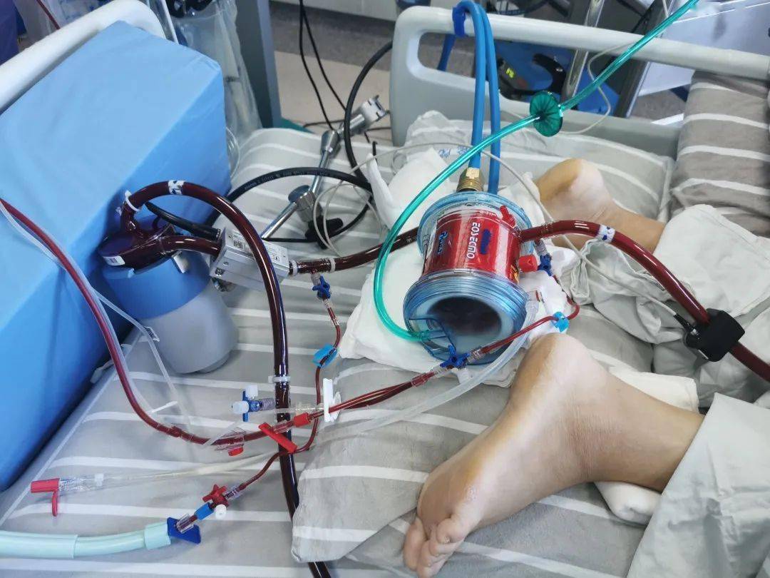 每百万人中仅有1到2人患这种病为抢救生命icu里展开乾坤大挪移