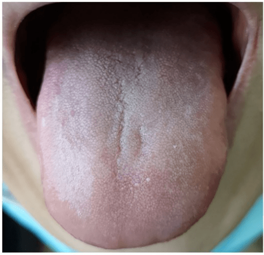 正常男性舌苔图片图片