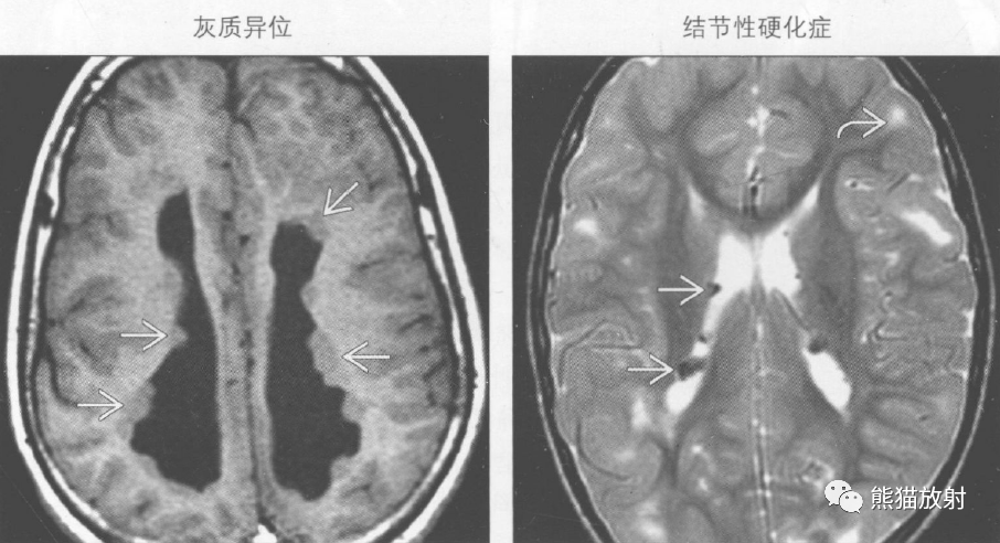 侧脑室影像图片图片