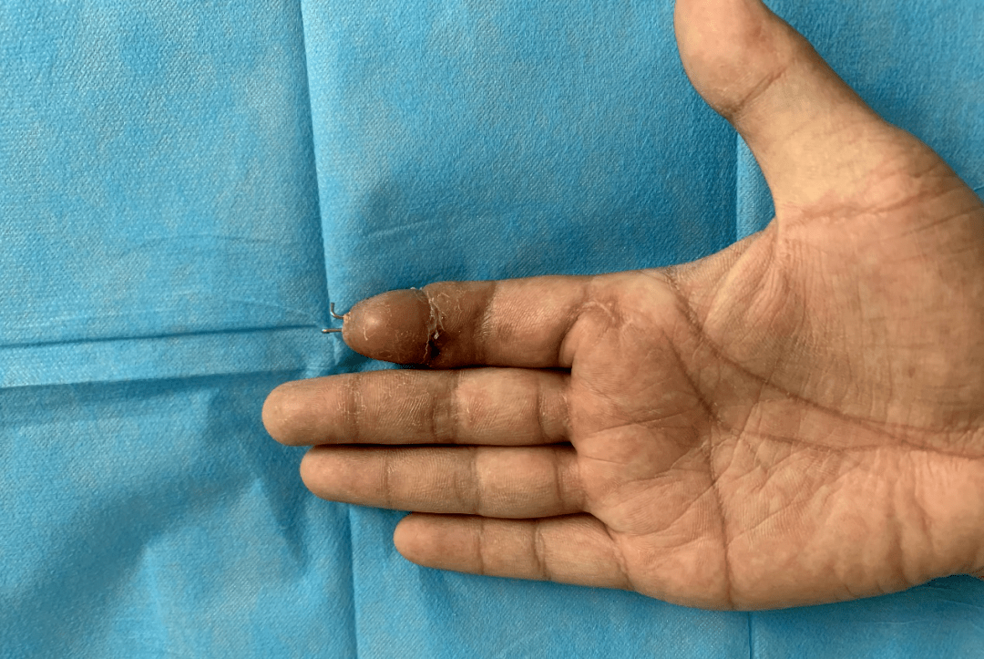 为西秀区人民医院点赞让伤者绞断的手指有了第二次生命