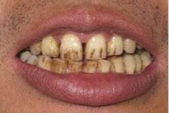 全都错了吸烟者用牙膏刷牙怪不得牙越来越黄