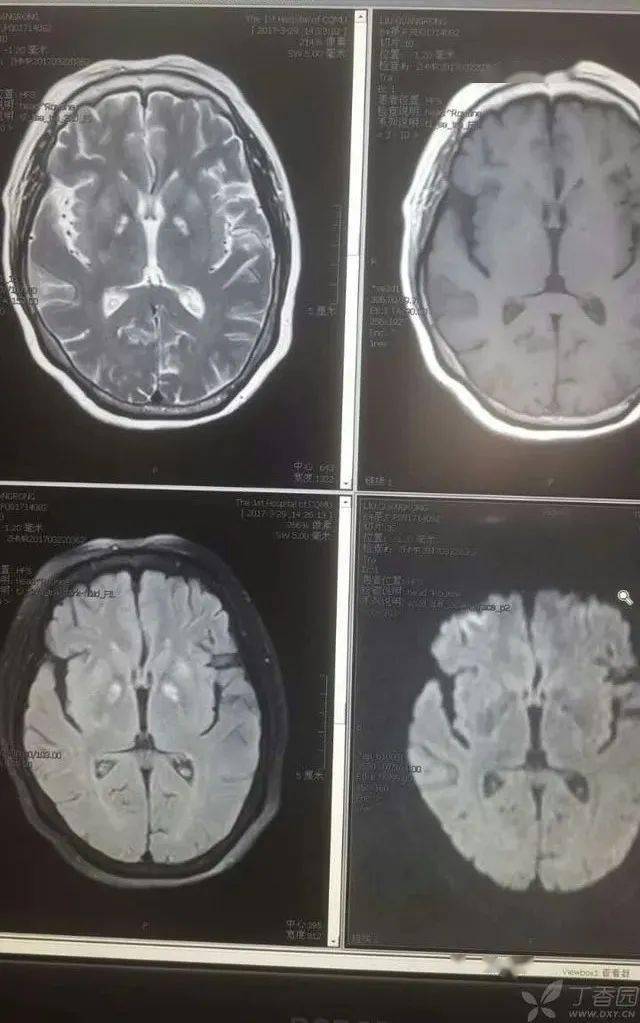 双侧瞳孔等大等圆,对光反射存在;双侧剑突平面以下痛觉消失;双上肢