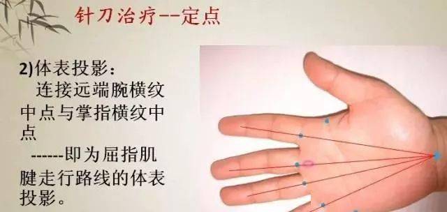 郭民庆针刀治疗女性图片