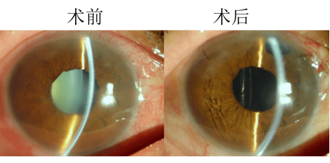 晶状体半脱位继发青光眼如何诊治听王涛教授授你换斗移星之策