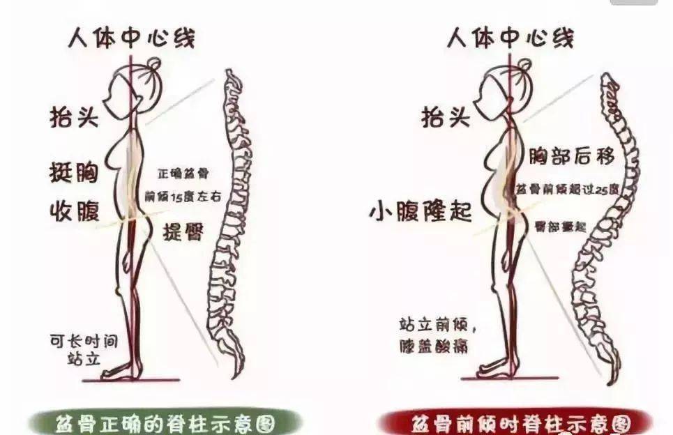 骨盆前傾如何診斷以及康復訓練方法