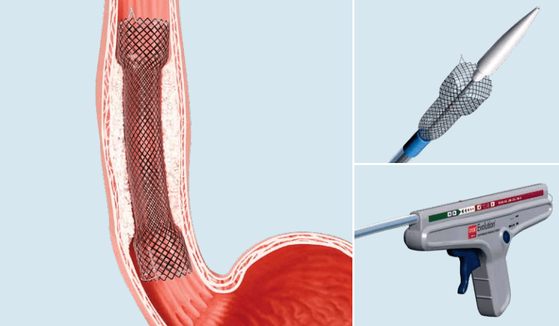 食管气管瘘支架图片