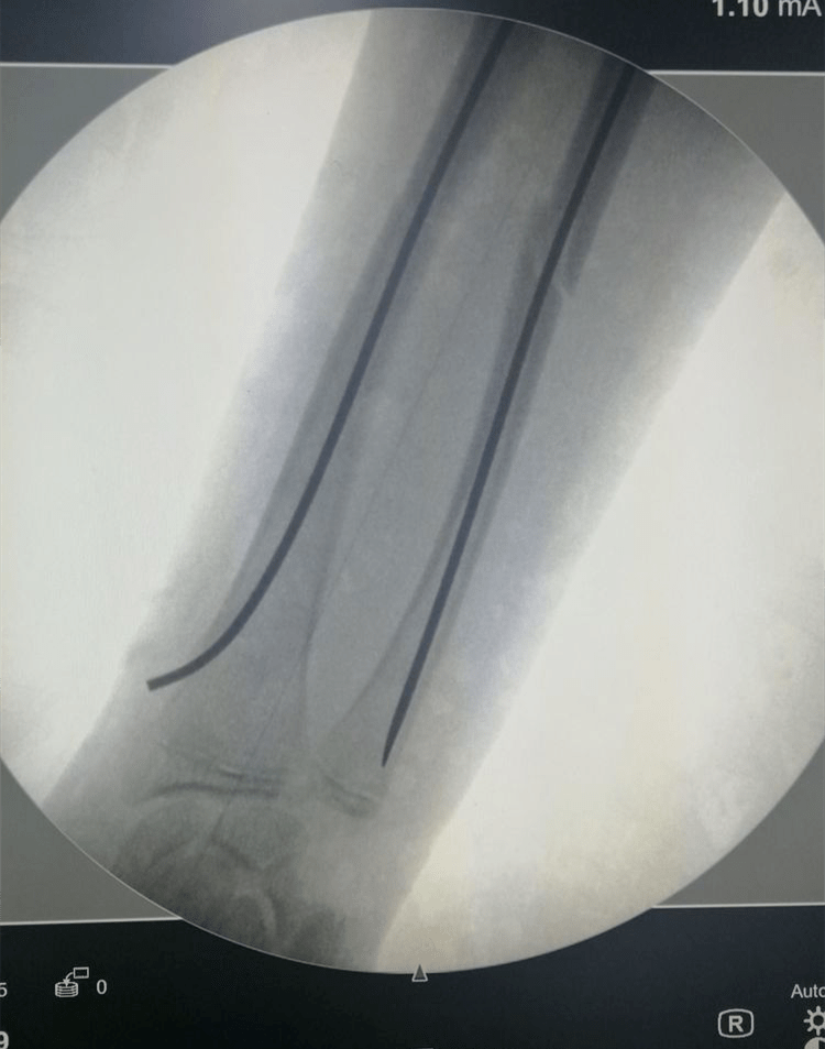 技术创伤骨一科完成两例弹性髓内针治疗小儿长骨骨折手术