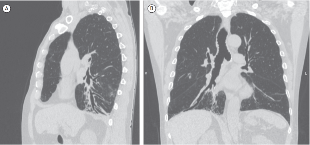 综述吞咽困难致吸入患者的胸部ct表现