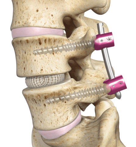 椎间融合微创optimesh可扩展椎间融合系统获得fda批准