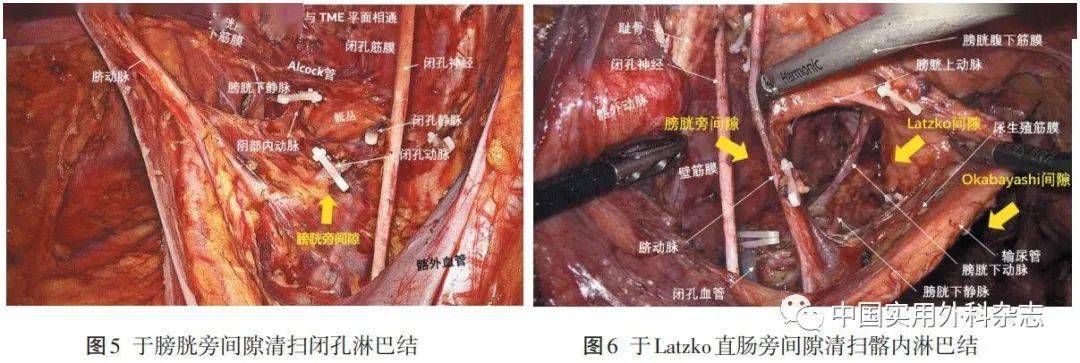 论著基于膜解剖的低位直肠癌侧方淋巴结两间隙清扫术安全性研究