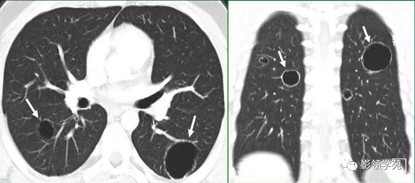 11种肺部囊样病变的影像表现