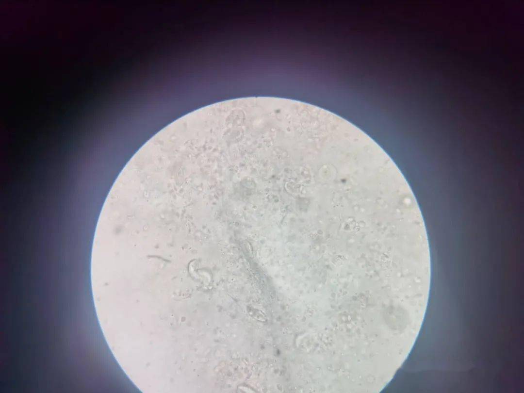 3,鳃霉引起的烂鳃,显微镜可见病原体菌丝进入鳃小片组织和软骨中生长